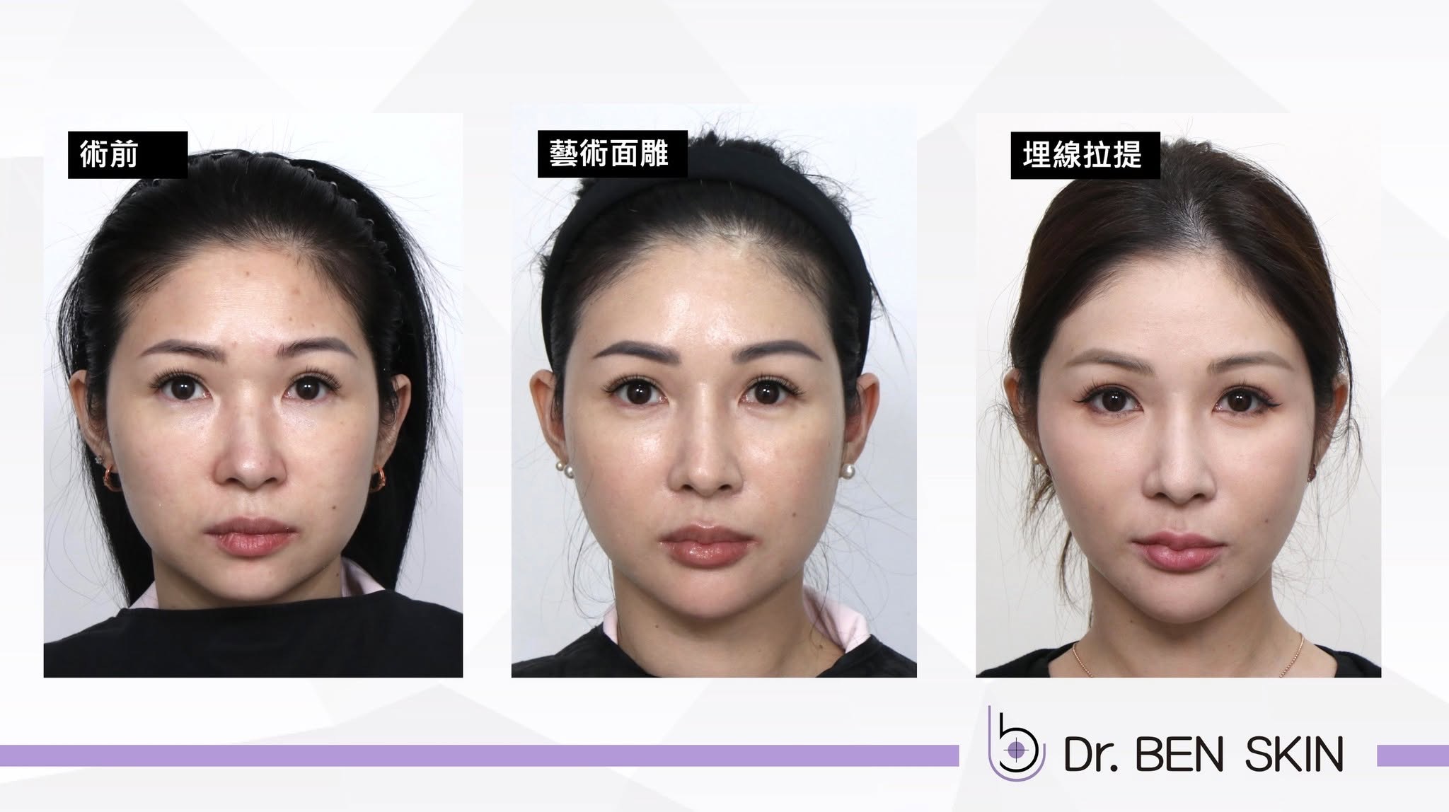 藝術面雕到埋線拉提三階段正面比較
